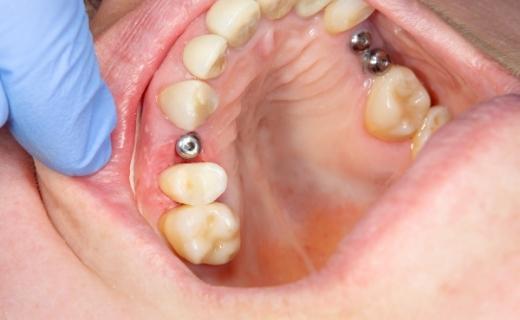 Fases en la colocación de implantes dentales 