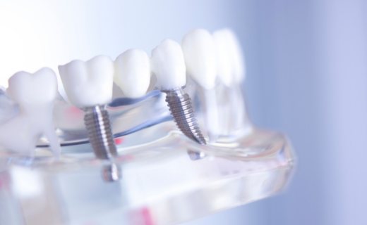 Implantes dentales en evolución 